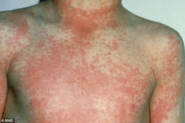 UK Scarlet Fever Outbreak Is Highest In 50 Years 1 UK Scarlet Fever Outbreak Is Highest In 50 Years 1