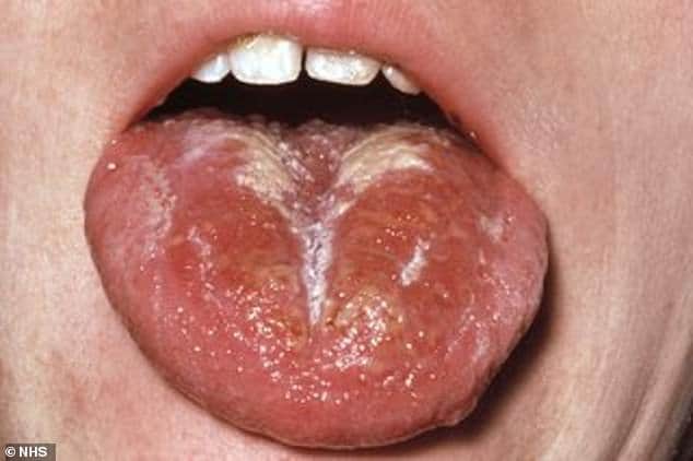 UK Scarlet Fever Outbreak Is Highest In 50 Years 3