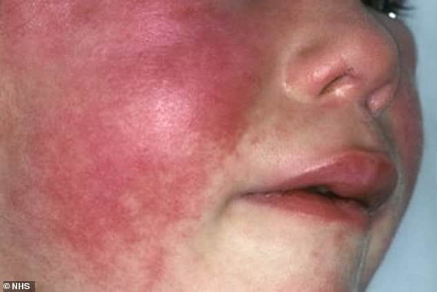 UK Scarlet Fever Outbreak Is Highest In 50 Years 2 UK Scarlet Fever Outbreak Is Highest In 50 Years 2