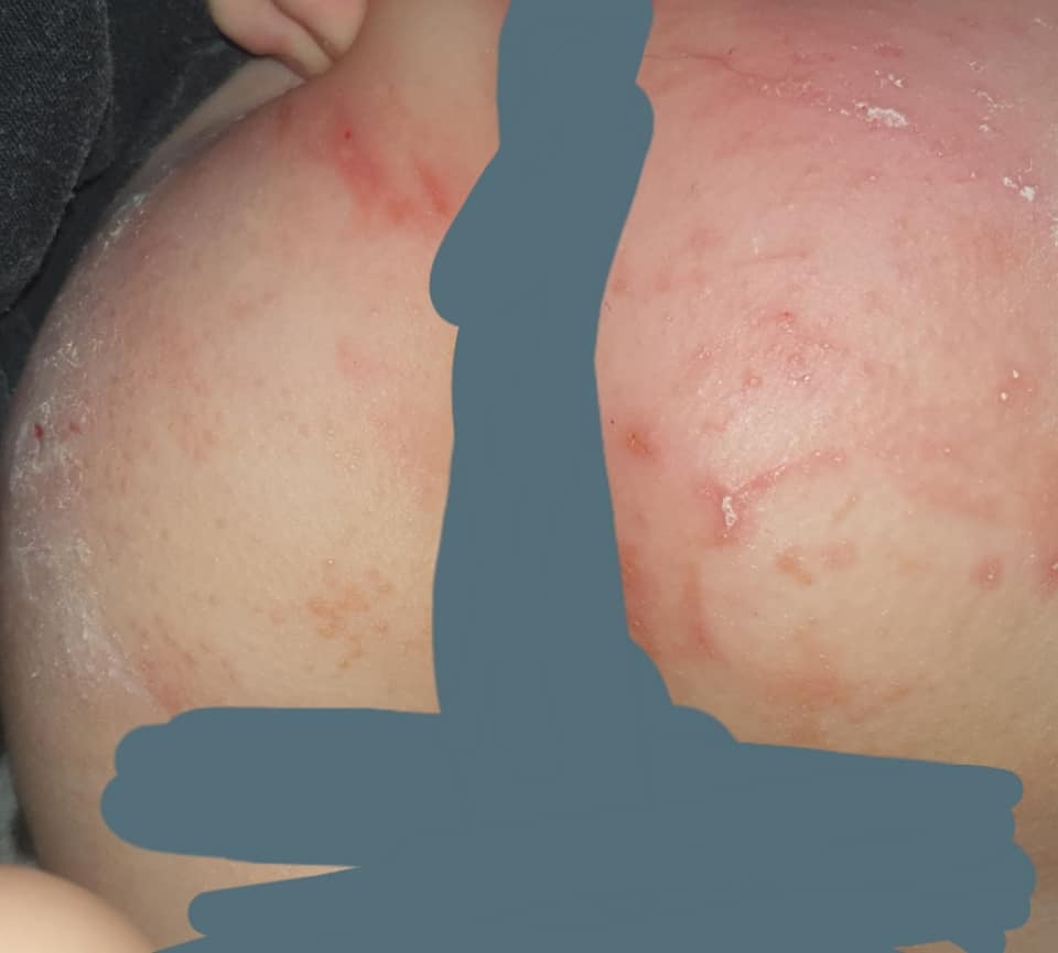 Mothers claim Aldi baby wipes have caused severe rashes and blisters 1 Mothers claim Aldi baby wipes have caused severe rashes and blisters 1