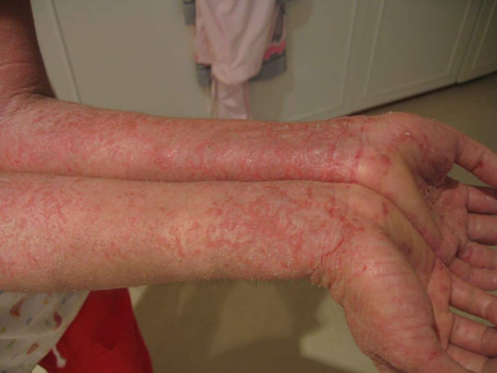 10 Helpful Tips About Eczema 1 eczema