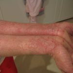 Eczema