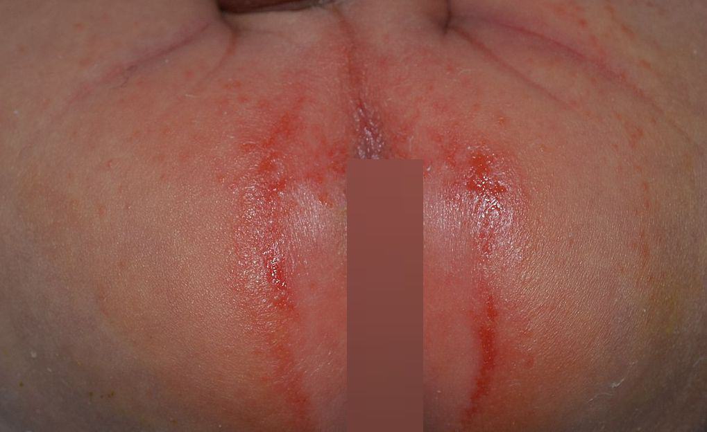 7 Triggers Of Nappy Rash 1 Nappy Rash