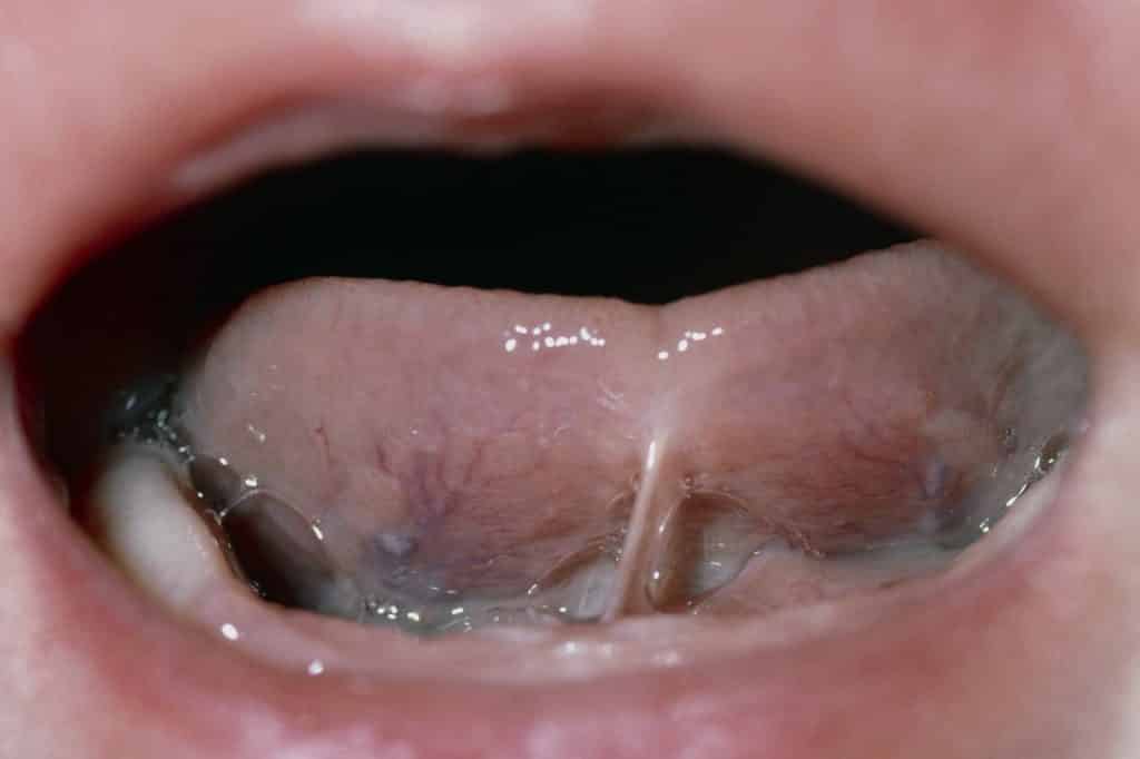Tongue-tie in babies 1 Tongue-tie in babies 1