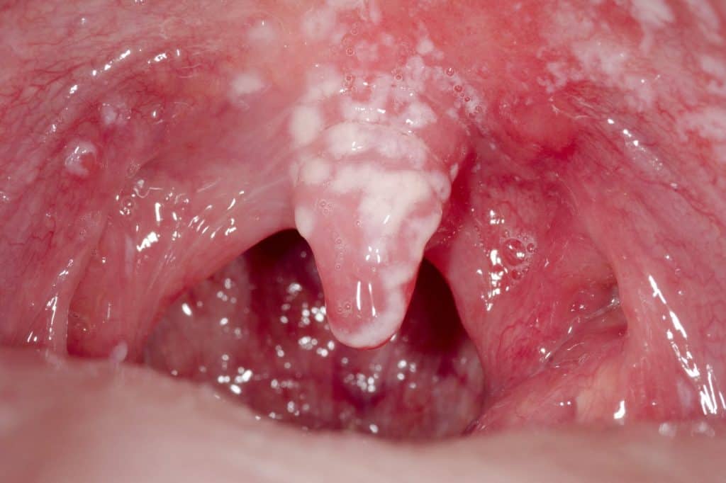 Has My Baby Got Oral Thrush? 1 Has My Baby Got Oral Thrush?