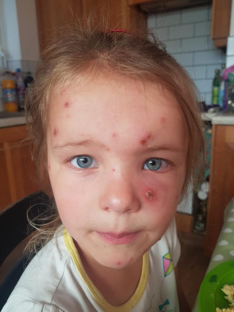 A Safer Tomorrow: The Joint Committee's Plan for Chickenpox Immunity 4