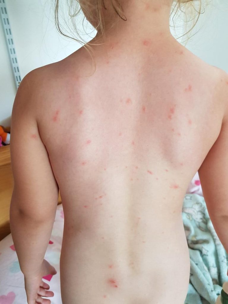 A Safer Tomorrow: The Joint Committee's Plan for Chickenpox Immunity 2